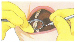 専用器具による歯石の除去
